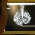 Falling breast cancer death rates have little to do with breast screening but are down to better treatment and health systems, scientists said on Friday, in a study likely to […]
