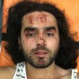 One of the injured activists beaten yesterday in the village of Shurnukh, Armenia. Facebook/Gay And Lesbian Armenian Society In a scene straight out of the Middle Ages, dozens of villagers in […]