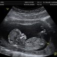 Right-wingers are now claiming that LGBTQ+ activists and members of the “Ivy League” are practicing “Neonatal Queer Theory,” a belief that doctors can “use sonograms to try and determine if […]